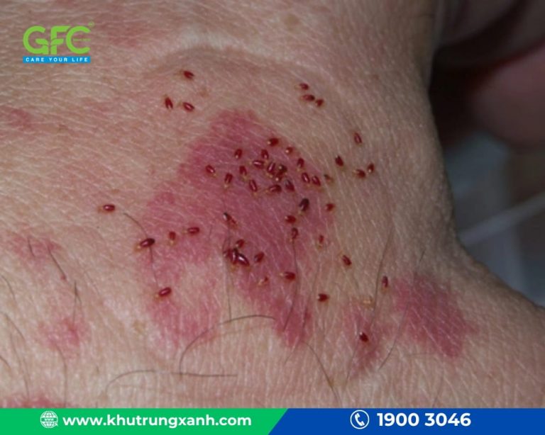 Cách diệt rệp giường hiệu quả, nhanh chóng nhất 2026